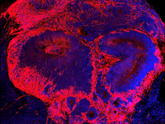 Increasing levels of a potential disease factor results in additional brain cells (red) in schizophrenia brain organoids or “mini-brains” developed from human embryonic stem cells in a lab. (Michael Notaras)