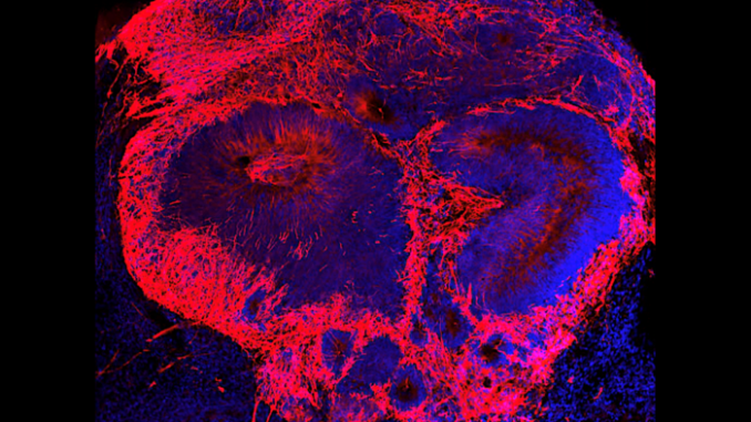 Increasing levels of a potential disease factor results in additional brain cells (red) in schizophrenia brain organoids or “mini-brains” developed from human embryonic stem cells in a lab. (Michael Notaras)